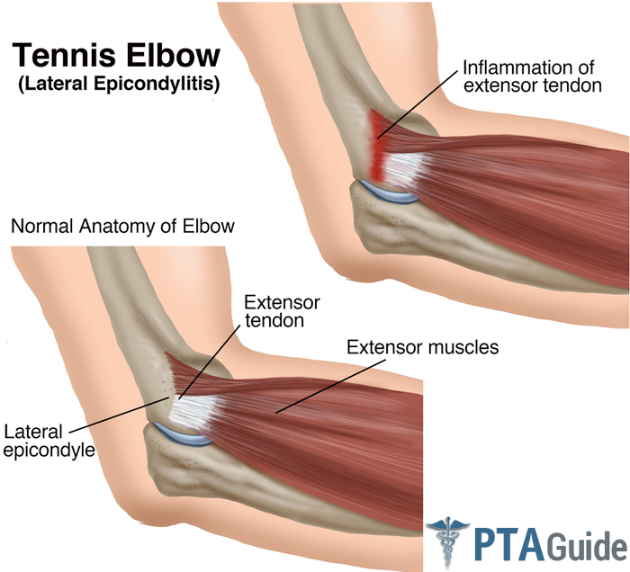 Tennis Elbow is caused by an inflamed extensor tendon