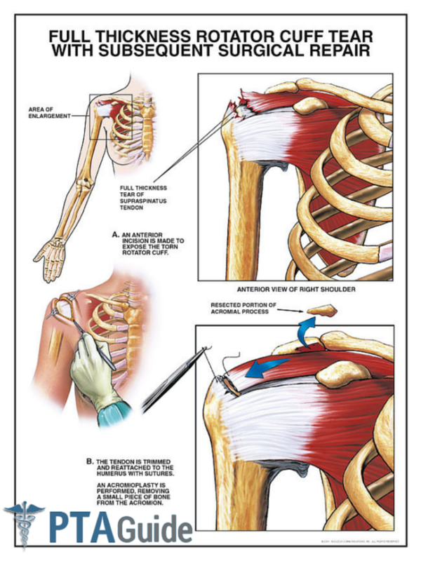 The Complete Rotator Cuff Tear Guide for Physical Therapy Assistants